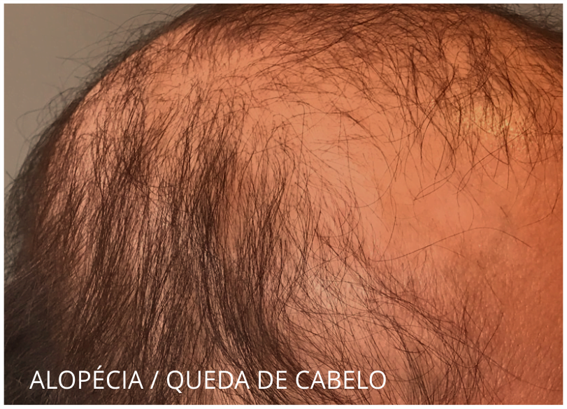 alopecia-queda-de-cabelo-pre-pos-operatorio