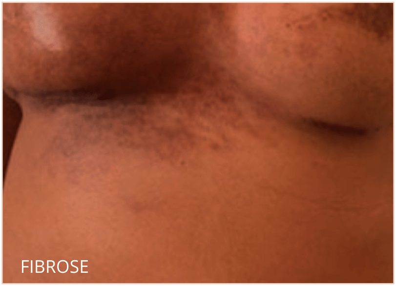 fibrose-pre-pos-operatorio