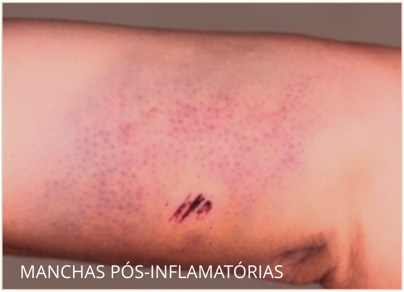 manchas-pos-operatorias-infamatorias