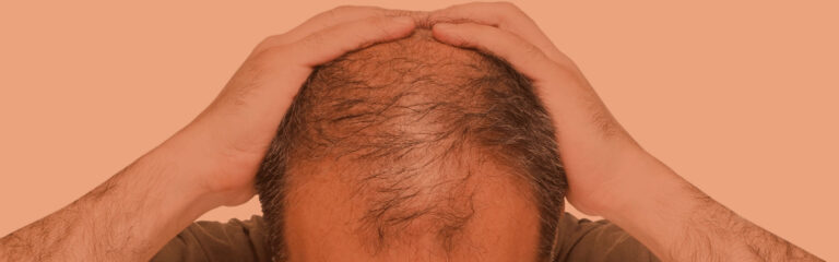 alopecia