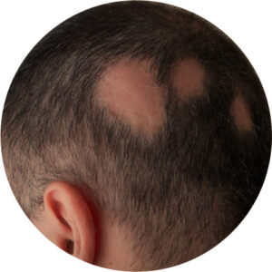 alopecias 02