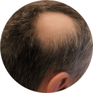 alopecias 03