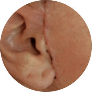 Cicatrizes 1 cicatrizes 01