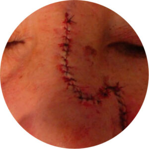 Cicatrizes 4 cicatrizes 04