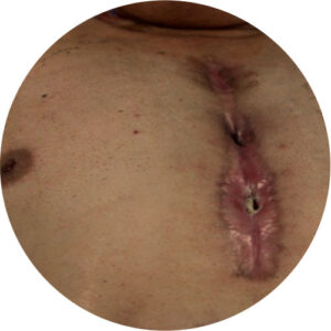 Deiscência 4 deiscencias 01