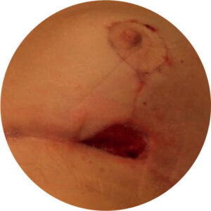 Deiscência 2 deiscencias 03