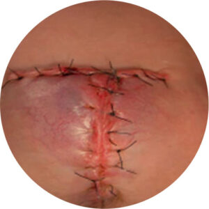 Deiscência 1 deiscencias 04