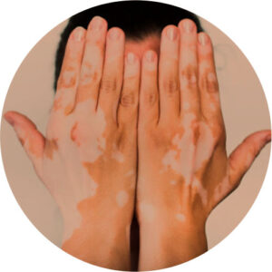 Discromias / Manchas 4 discromias 01