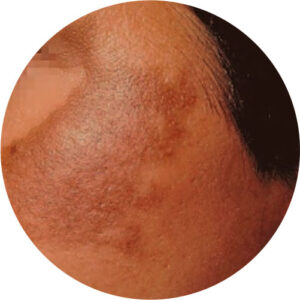 Discromias / Manchas 2 discromias 03