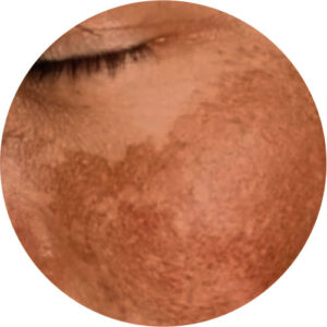 Discromias / Manchas 1 discromias 04