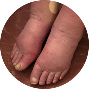 Edemas, Varizes & Lipedema 1 edema 01