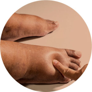 Edemas, Varizes & Lipedema 3 edema 03