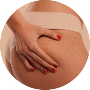 Estrias 1 estrias 01