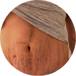 Estrias 3 estrias 03