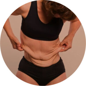 Flacidez 1 flacidez 01