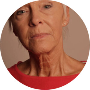 Flacidez 2 flacidez 02