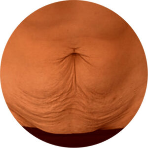 Flacidez 3 flacidez 03