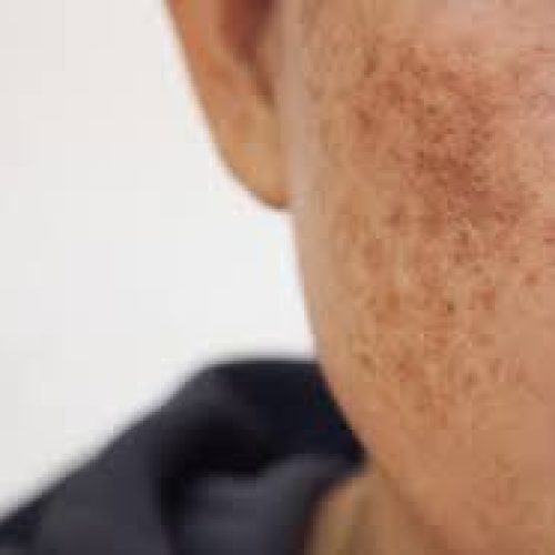 melasma